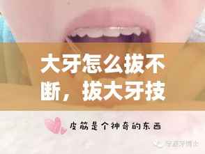 大牙怎么拔不断,拔大牙技巧