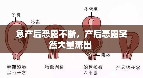 急产后恶露不断，产后恶露突然大量流出 